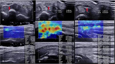 Ultrasound and elastography role in pre- and post-operative evaluation of median neuropathy in patients with carpal tunnel syndrome